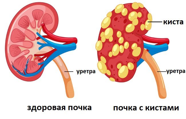 Что такое поликистоз почек у кошек